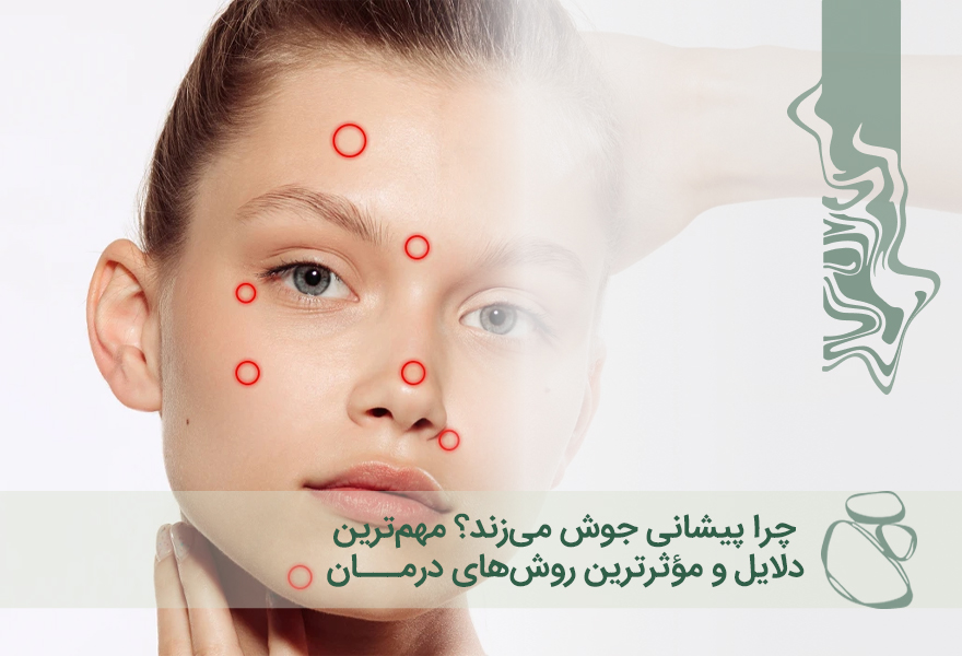 چرا پیشانی جوش می‌زند؟ مهم‌ترین دلایل و مؤثرترین روش‌های درمان